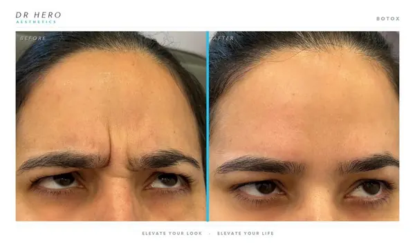 Dr Hero before and after