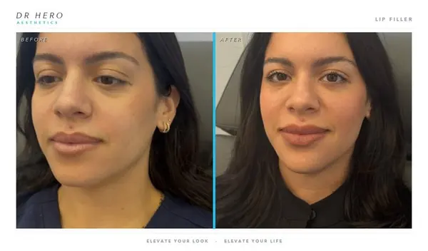 Dr Hero before and after