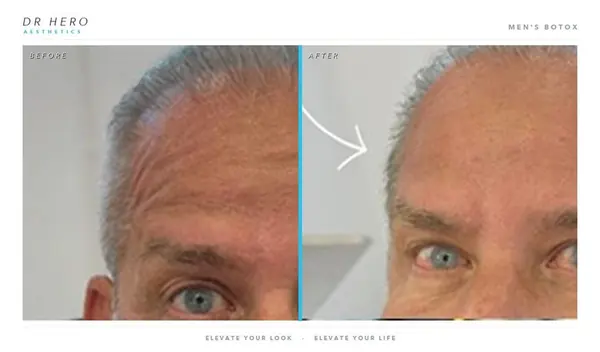 Dr Hero before and after