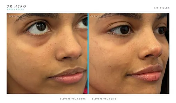 Dr Hero before and after