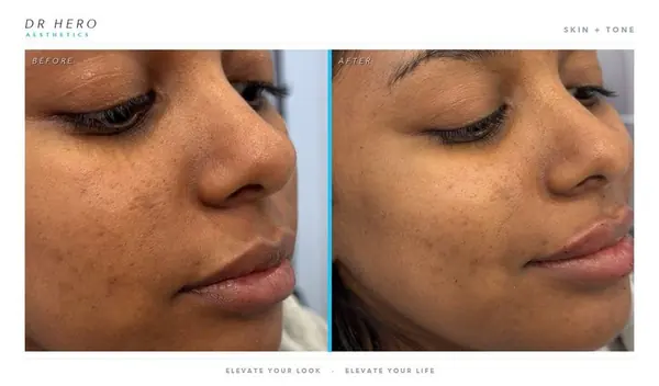 Dr Hero before and after