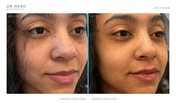 Dr Hero before and after
