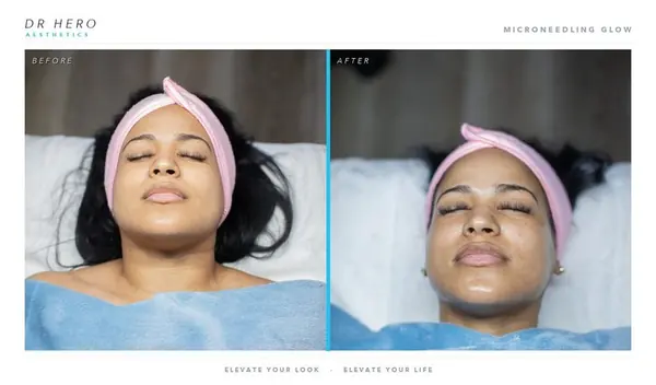 Dr Hero before and after