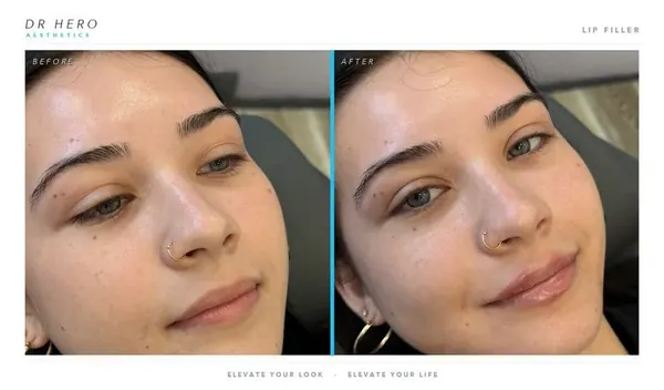 Dr Hero before and after
