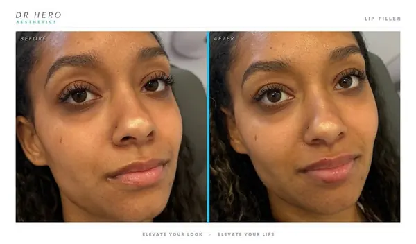 Dr Hero before and after
